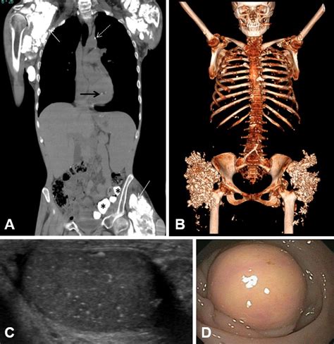 Figure 1 A Computed Tomography Ct Scan Genereviews® Ncbi Bookshelf