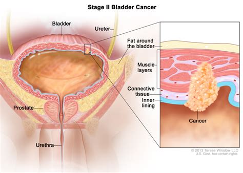 Bladder Cancer Treatment PDQ Cancer Information Summaries NCBI