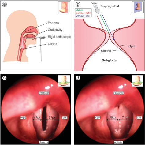 A Principle Of Laryngoscopy With View Onto The Sagittal Plane B Download Scientific