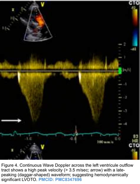 Dynamic Left Ventricular Outflow Tract Obstruction Underestimated