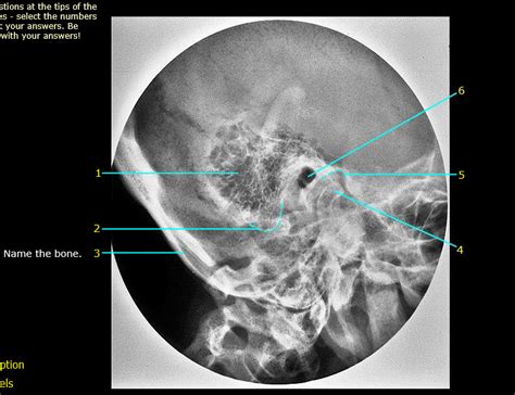 Mastoid Air Cells Diagram