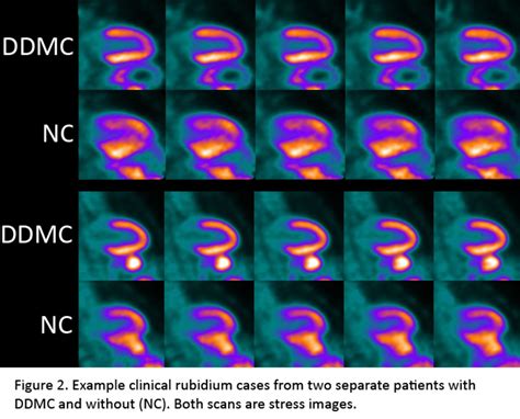 Data Driven Motion Correction For Cardiac Pet Journal Of Nuclear Medicine