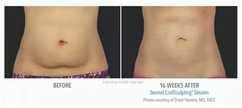 Coolsculpting Before And After Pictures In Nyc Skinney Medspa