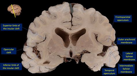 Neuroanatomy Sylvian Fissure Treatment And Management Point Of Care