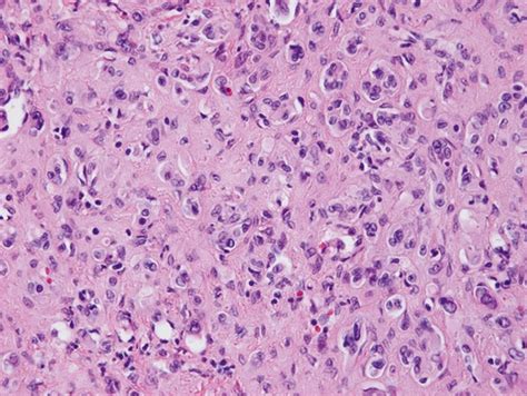 11 Endothelial Cells Are Arranged In Small Clusters In This Epithelioid