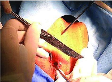 D Reconstruction Of Ct Scan Where The Position Direction And