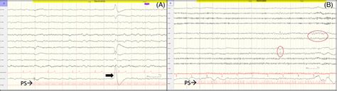 EEG During Photic Stimulation A Photic Driving At 10 Hz In A Healthy