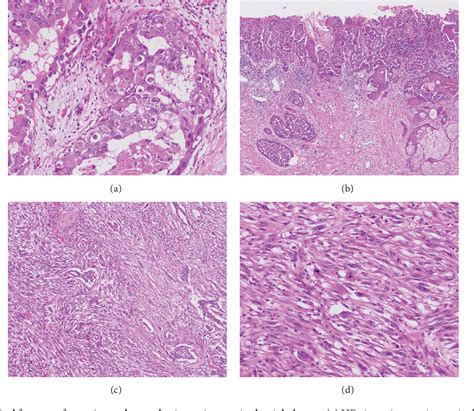 Table 1 From Her2 Positive Metaplastic Spindle Cell Carcinoma