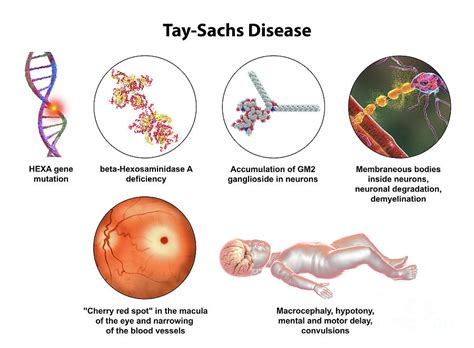 Tay-sachs Disease #13 by Science Photo Library