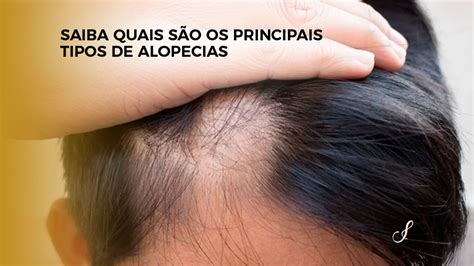 Saiba Quais São os Principais Tipos de Alopecias Clínica Infiniti