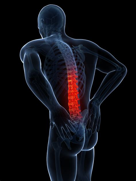 Atlanta Lumbar Spondylosis Treatment Georgia Spinal Osteoarthritis