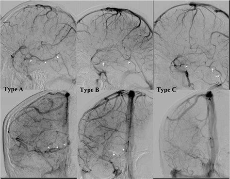 The Relationship Between Perimesencephalic Subarachnoid Hemorrhage And