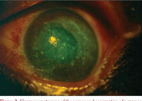 Gender Difference In Ocular Diseases Risk Factors And Management With Specific Reference To