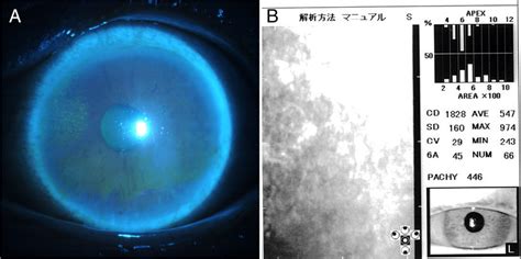 Slit Lamp Examination Photographs Of A Patient With Corneal