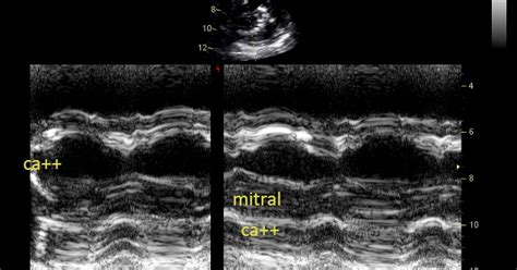 Echovar Eco Del Dia La Calcificaci N Del Anillo Mitral