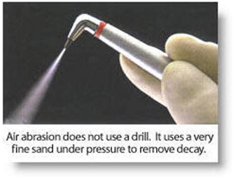 ONLINE DENTISTRY: AIR ABRASION - MINIMALLY INVASIVE TECHNIQUE