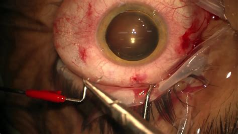 Retina Tear Surgery 3 YouTube