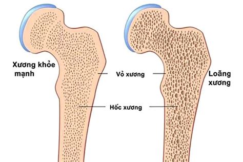 Dấu hiệu đau xương khớp và cảnh báo những bệnh nguy hiểm Nichiei Asia