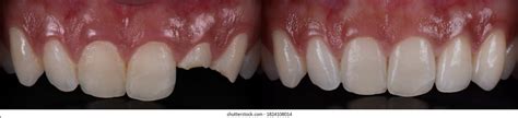 Before After 2 All Ceramic Dental Stock Photo 1824108014 | Shutterstock