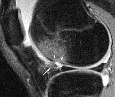 MRI Of Osteochondral Defects Of The Lateral Femoral Condyle Incidence