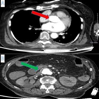 Computed Tomography Angiogram CTA Chest And CTA Abdomen And Pelvis Of