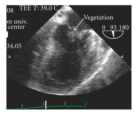 Infective Endocarditis Echo