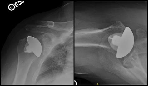 Anatomic Total Shoulder Arthroplasty