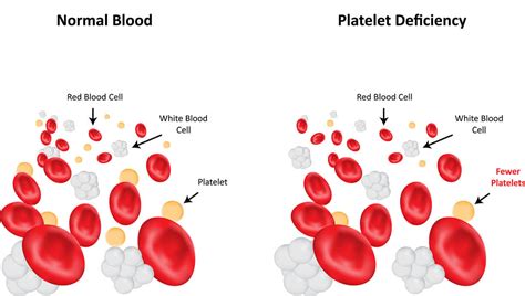 Low Blood Platelets (Thrombocytopenia) in Cats - Cat-World