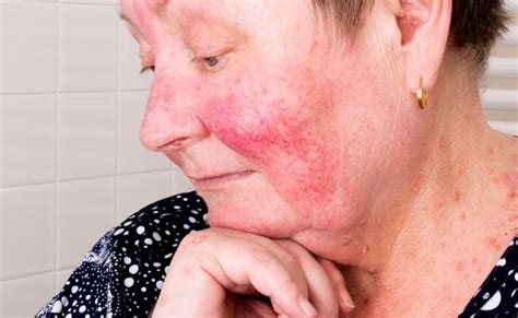 Rosacea Definition Facts Causes And Treatments Otosection