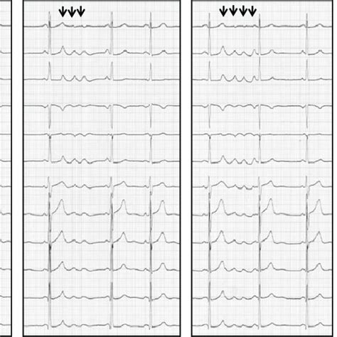 Twelve Lead Electrocardiograms Were Recorded From A Year Old