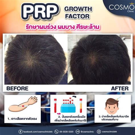 ตอบคำถามยอดฮิต เรื่อง PRP ผม | cosmo hair center