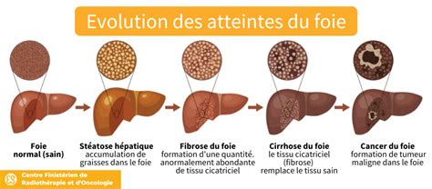 Cancer Du Foie Sympt Mes Esp Rance De Vie Oncologie Brest