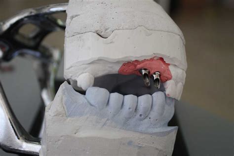 Implants With A Cantilever