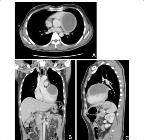 Ct Chest Shows A Large Well Defined Cystic Lesion With Multiple Download Scientific Diagram