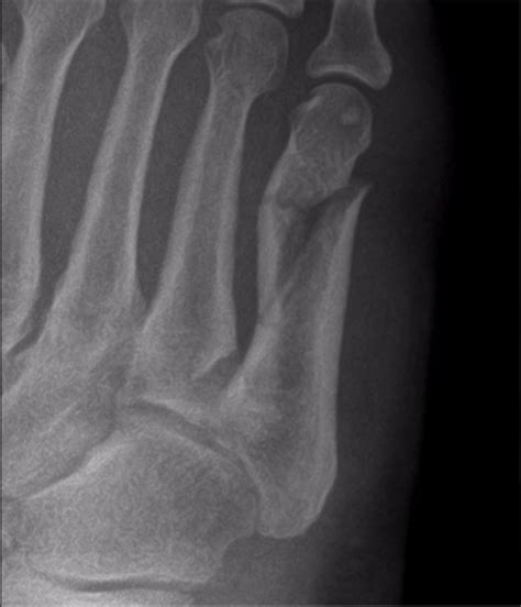 Reconstructive Surgical Option For A Comminuted Fifth Metatarsal