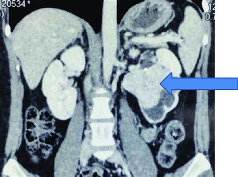 Contrast Enhanced Computed Tomography Ct Showing Left Renal Mass At Download Scientific