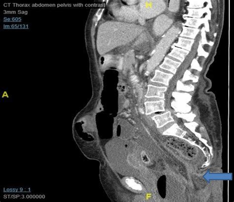 Closed Loop Obstruction And Adhesive Intestinal Obstruction In Perineal