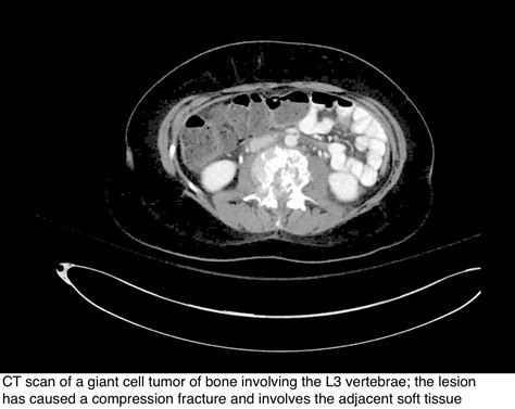 Pathology Outlines Giant Cell Tumor Of Bone