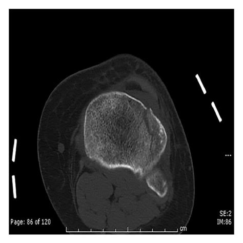 Mri Of Left Knee Showing Popliteofibular Ligament Tear And Edema In