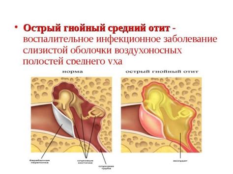 Острый средний отит - причины, симптомы, диагностика и лечение