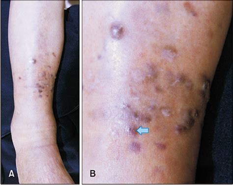 Kaposi Sarcoma In A Patient With Bullous Pemphigoid Treated With Low