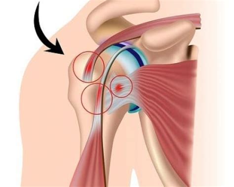 Rupture de la coiffe des rotateurs Dr Ghamgui Chirurgien orthopédiste