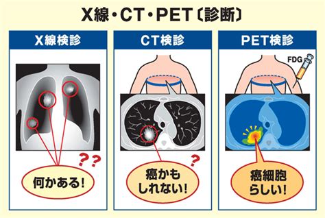 癌 Ct検査 造影剤 Hello Doctor