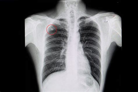 10 Steps for Identifying and Treating Pulmonary Nodules - Facty Health