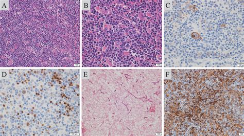 Figure From A Difficult Case Of Angioimmunoblastic T Cell Lymphoma