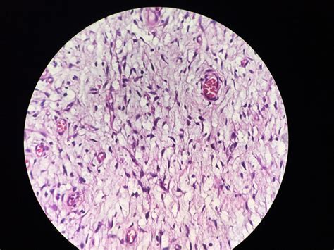 Characteristic storiform pattern seen in patient with DFSP | Download ...