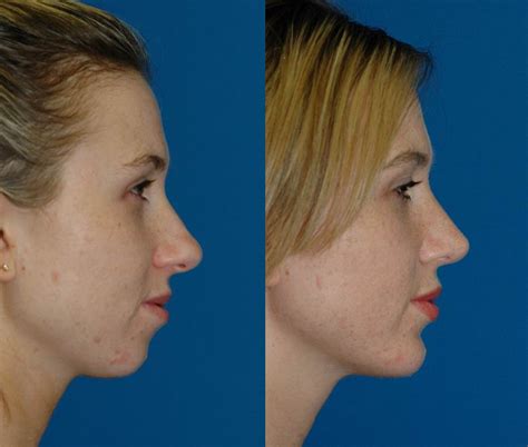 Chin Implant Seattle Chin Augmentation Genioplasty