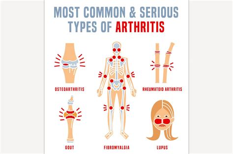 Arthritis types infographic | Icons ~ Creative Market