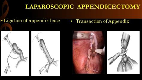 Laparoscopic Appendicectomy Operative Surgery