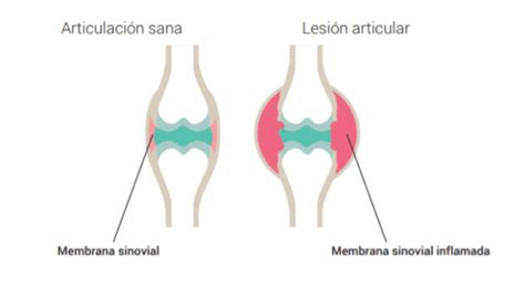 Artritis Reumatoide Qué Es Síntomas Diagnóstico Y Tratamiento El